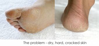 Fórmula Original de la Cáscara del Pie de Dr Kimoto - Tratamiento Casero Increíble para los Pies - 2 Pares - Diga Adiós a Piel Duro y Seco de Pie & Diga Hola a Pies Suaves de Bebé!. Envíos a M&