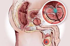 MASAJE PROSTATICO PARA CABALLEROS EVITA SER PRECOS ERECSIONES FUERTES